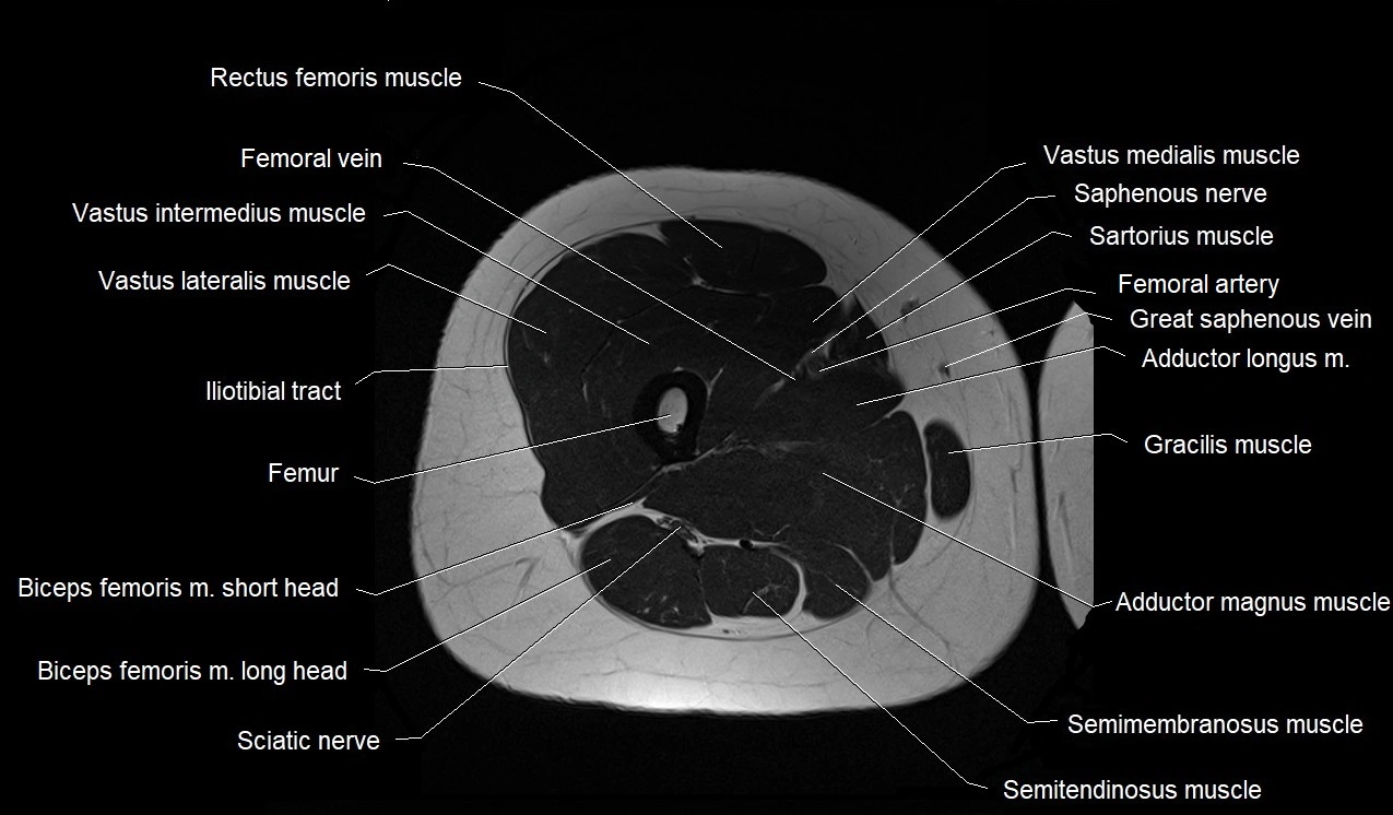 MRI thigh cross sectional anatomy image 28.webp